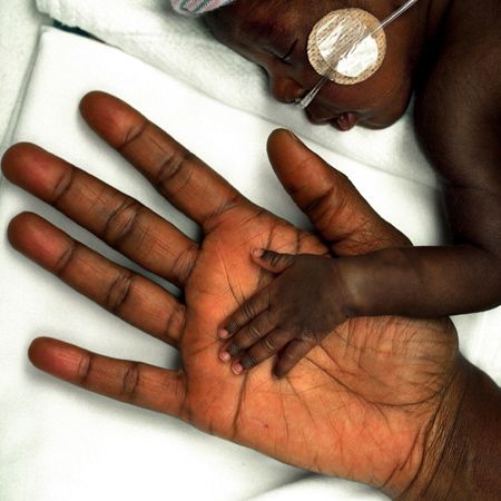 The hand of a neonatal intensive care nurse and that of a 12-week-old, 2 lb., 7.8 oz. baby. NEONATAL BABY