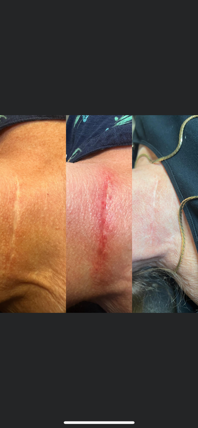 Scar Removal