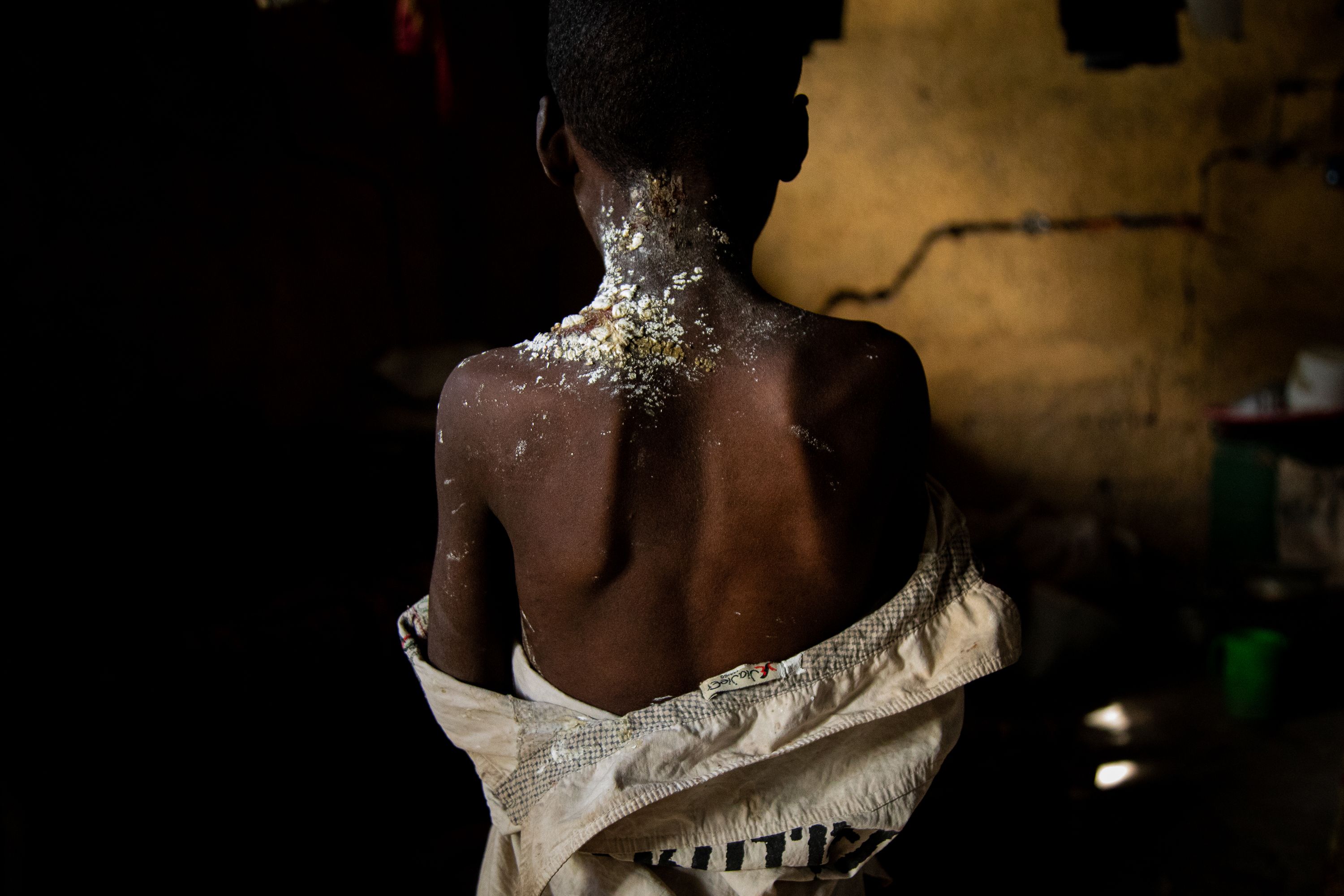 Mehari Gebremeskel, 8, turns his back to the camera to display a fungal disease on his neck likely caused by the unhygienic conditions in the camp for internally displaced where he lives along with other 7,000 people in Shire, Tigray, Ethiopia. According to the International Organization for Migration, 1.8 million people are currently displaced in Tigray. Tigray'sPeacetimeCasualties_04002023-018.jpg