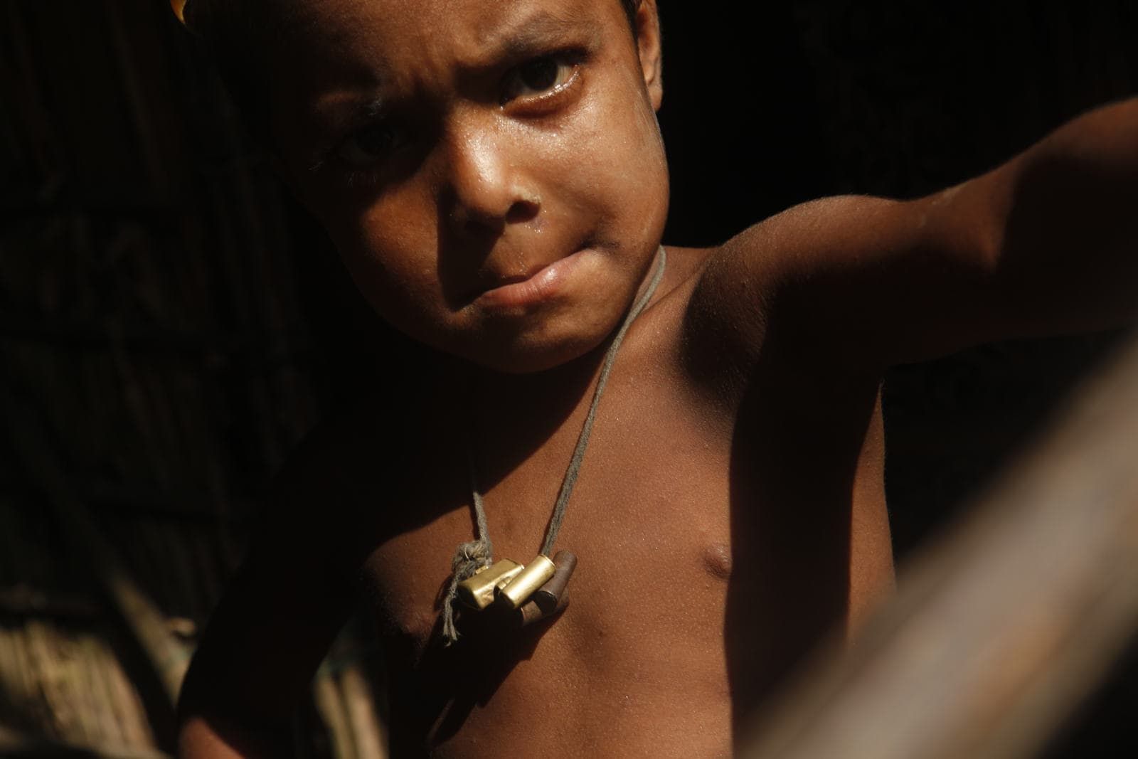 A community health worker visits a child suffering from malnutrition. The child is wearing an amulet from a local witch doctor for good health.