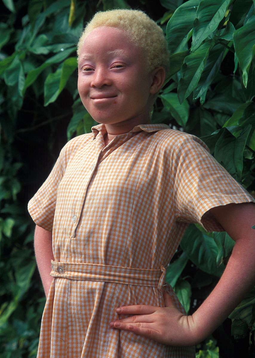 1africa_albino_copy.jpg