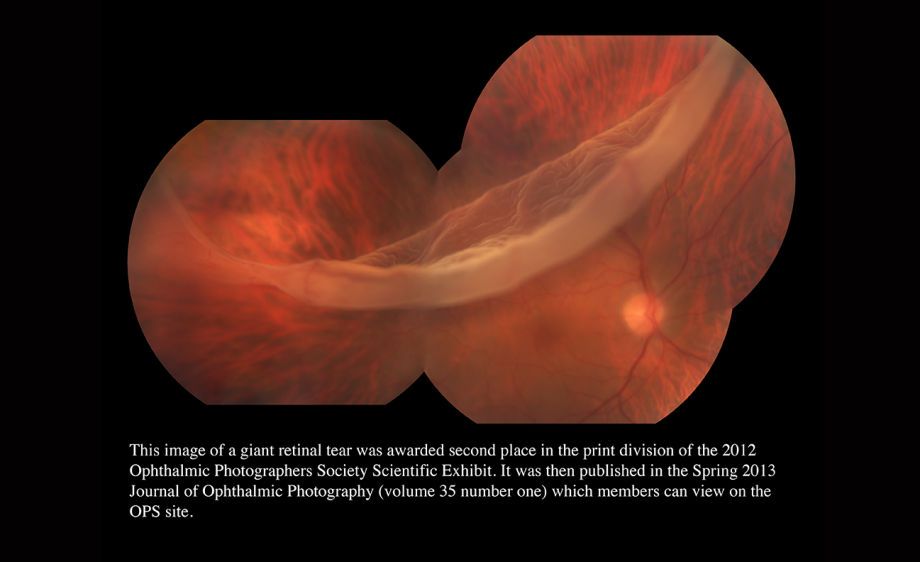 1giant_retinal_tear_page.jpg