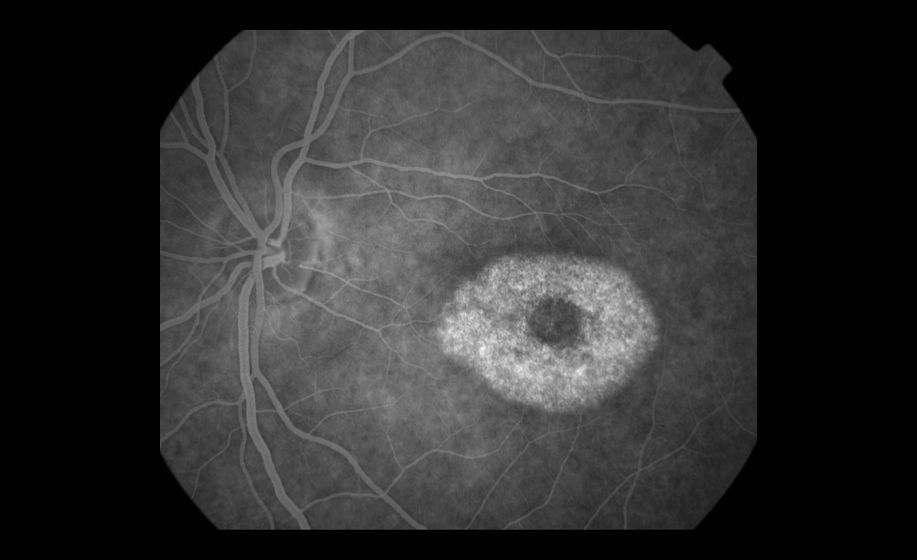 1bulls_eye_maculopathy_03.jpg
