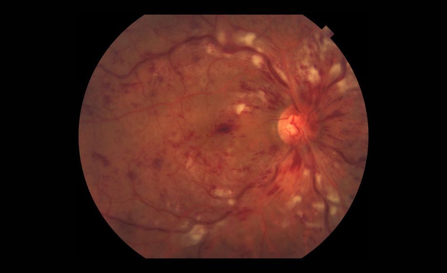Central Retinal Vein Occlusion