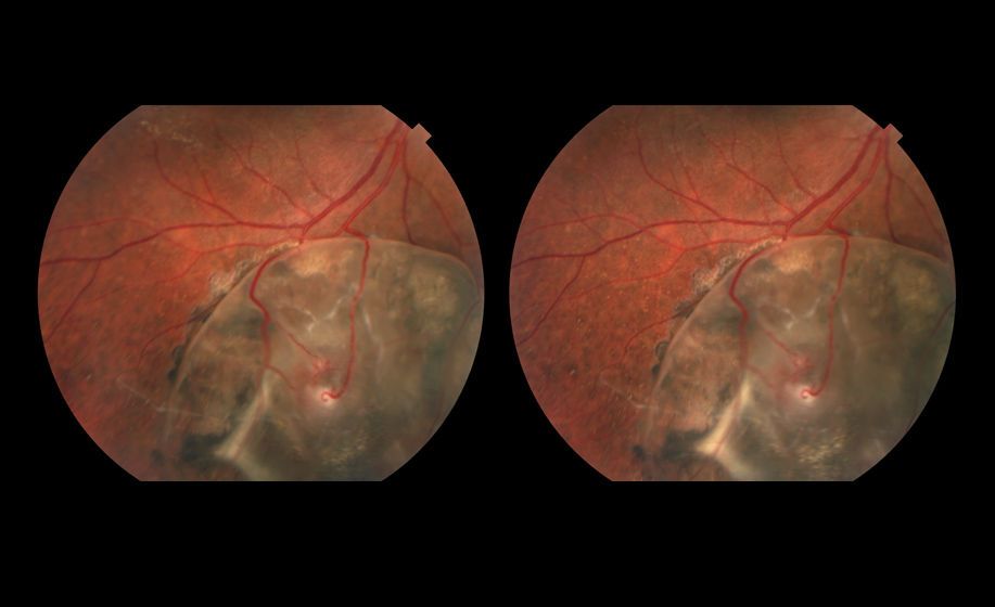 Idiopathic Uveal Effusion Syndrome