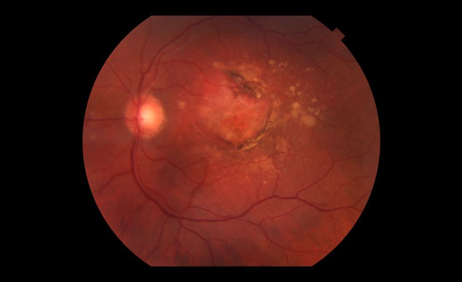 Macular Degeneration