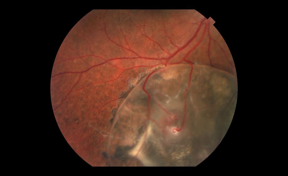 Idiopathic Uveal Effusion Syndrome