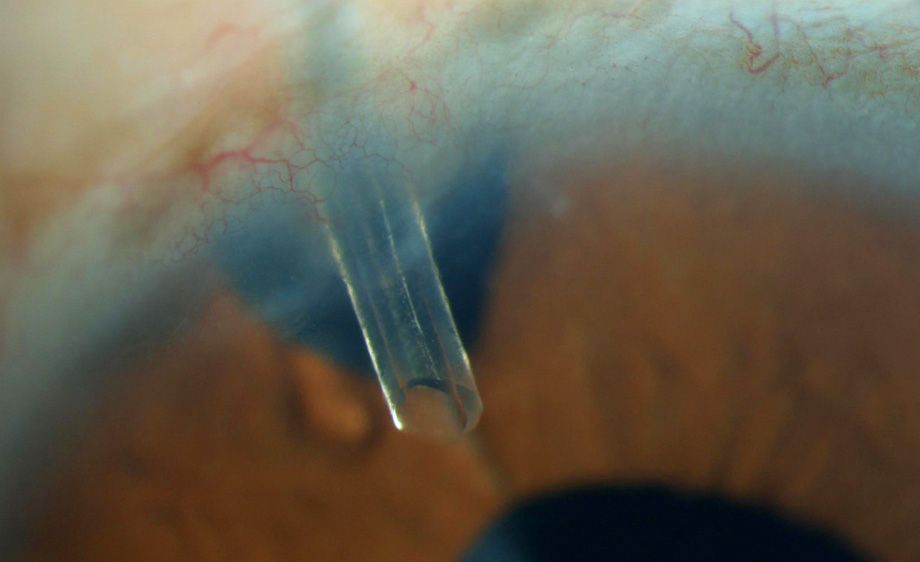 1anterior_chamber_drain.jpg