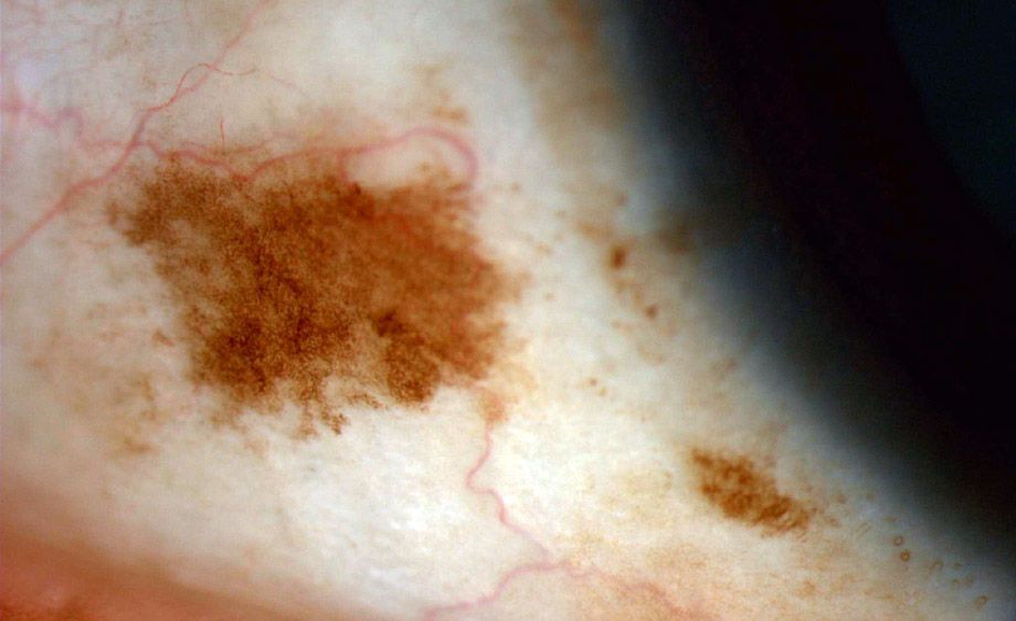 Conjunctival Nevus