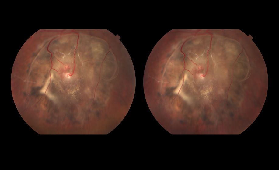 Idiopathic Uveal Effusion Syndrome