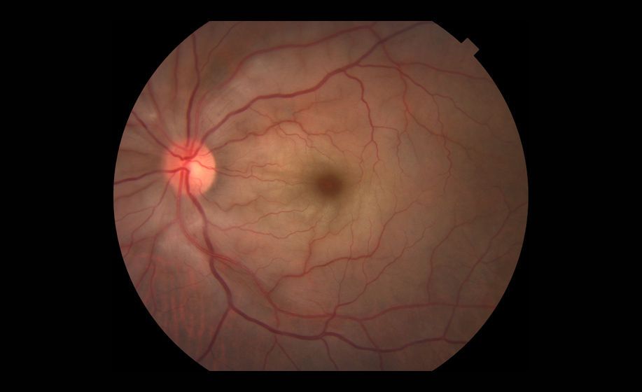 Central Retinal Artery Occlusion