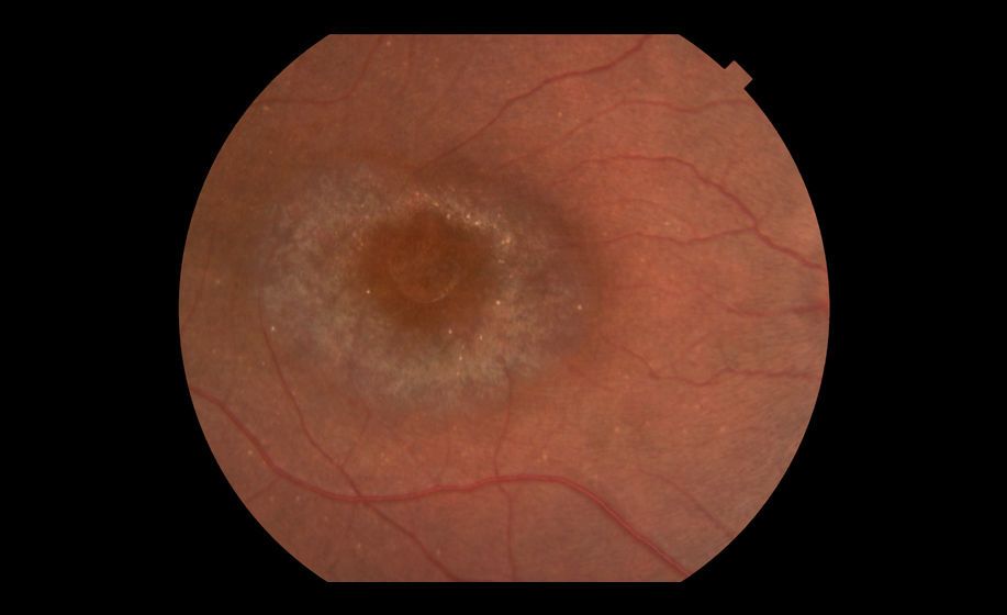 1bulls_eye_maculopathy_02.jpg