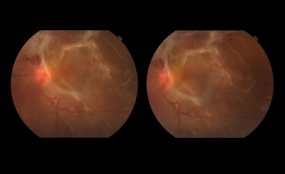 Diabetic Retinopathy