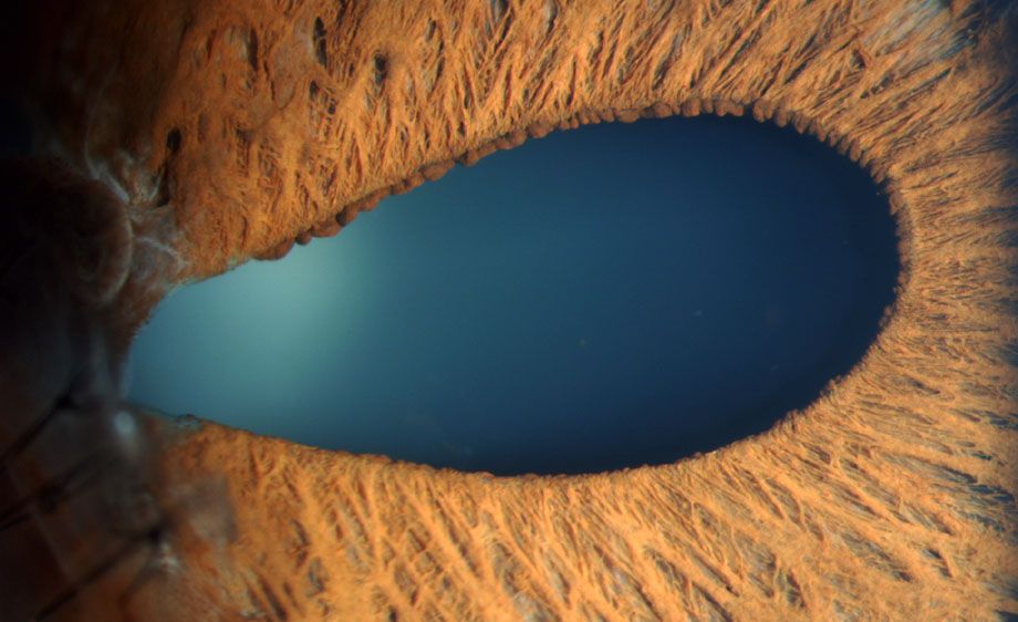 Damaged Iris resulting from a puncture wound.