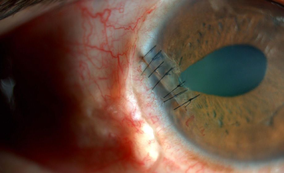 Corneal Sutures
