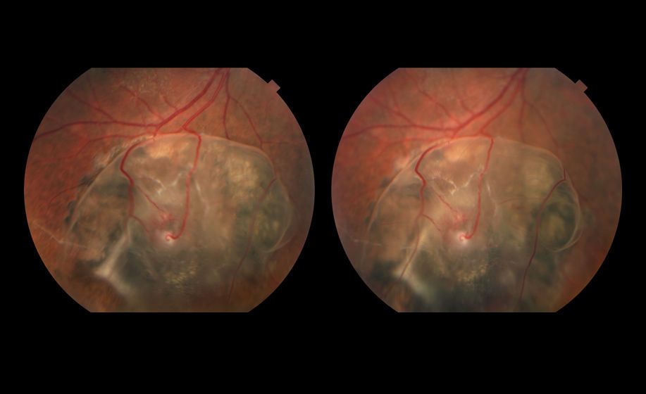 Uveal Effusion Syndrome