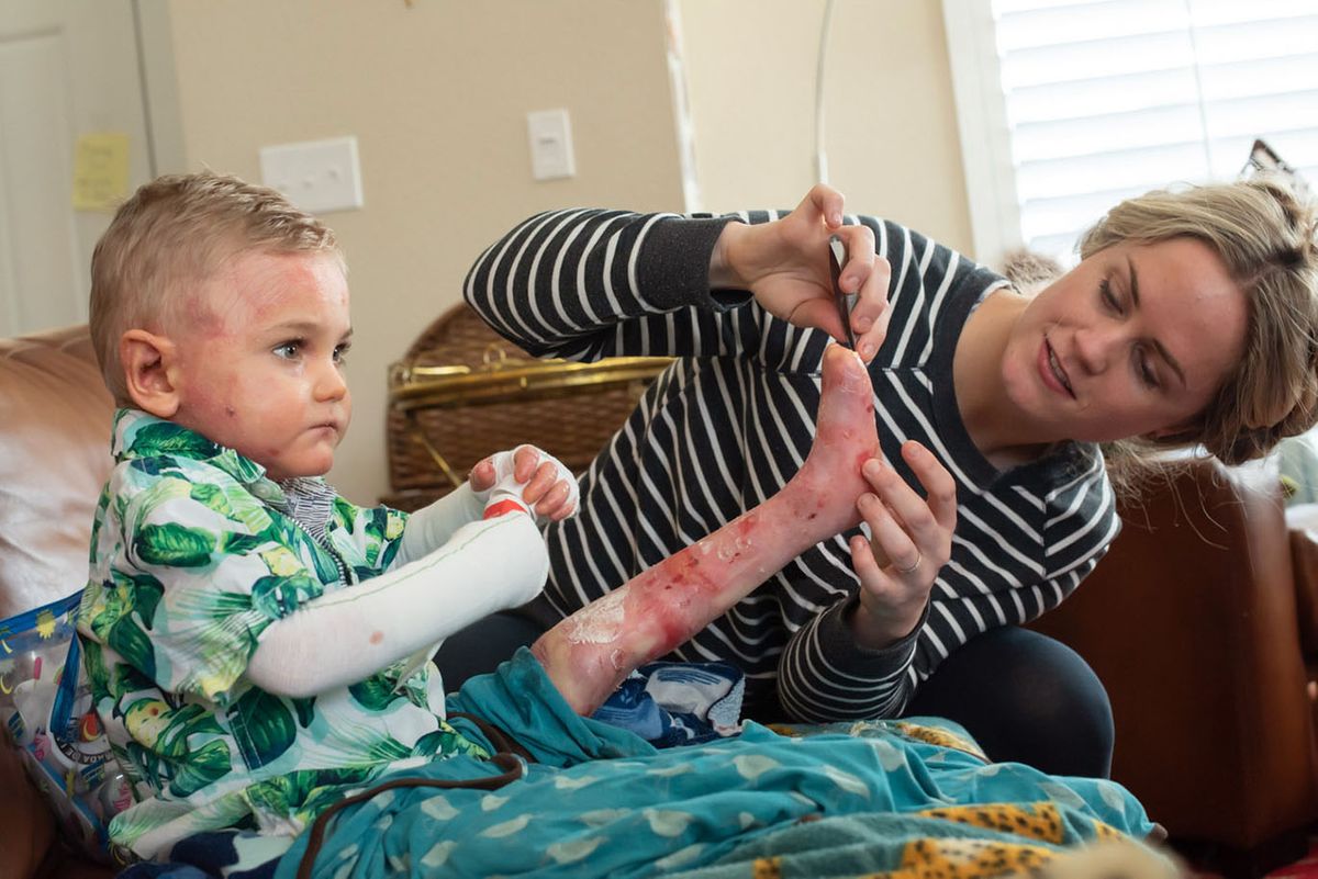 Editorial photography for medical journal depicting daily care needed for EB skin disease. EB Skin Disease Bandages.