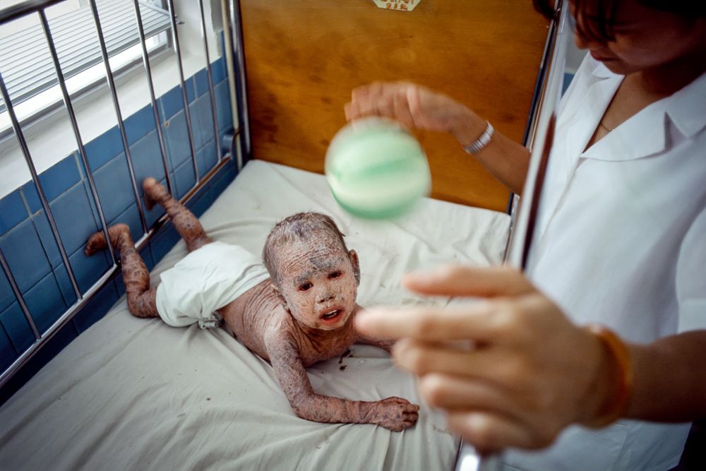 Agent Orange poisoning. Ho Chi Minh City, Vietnam. agent.orange_01 copy.jpg