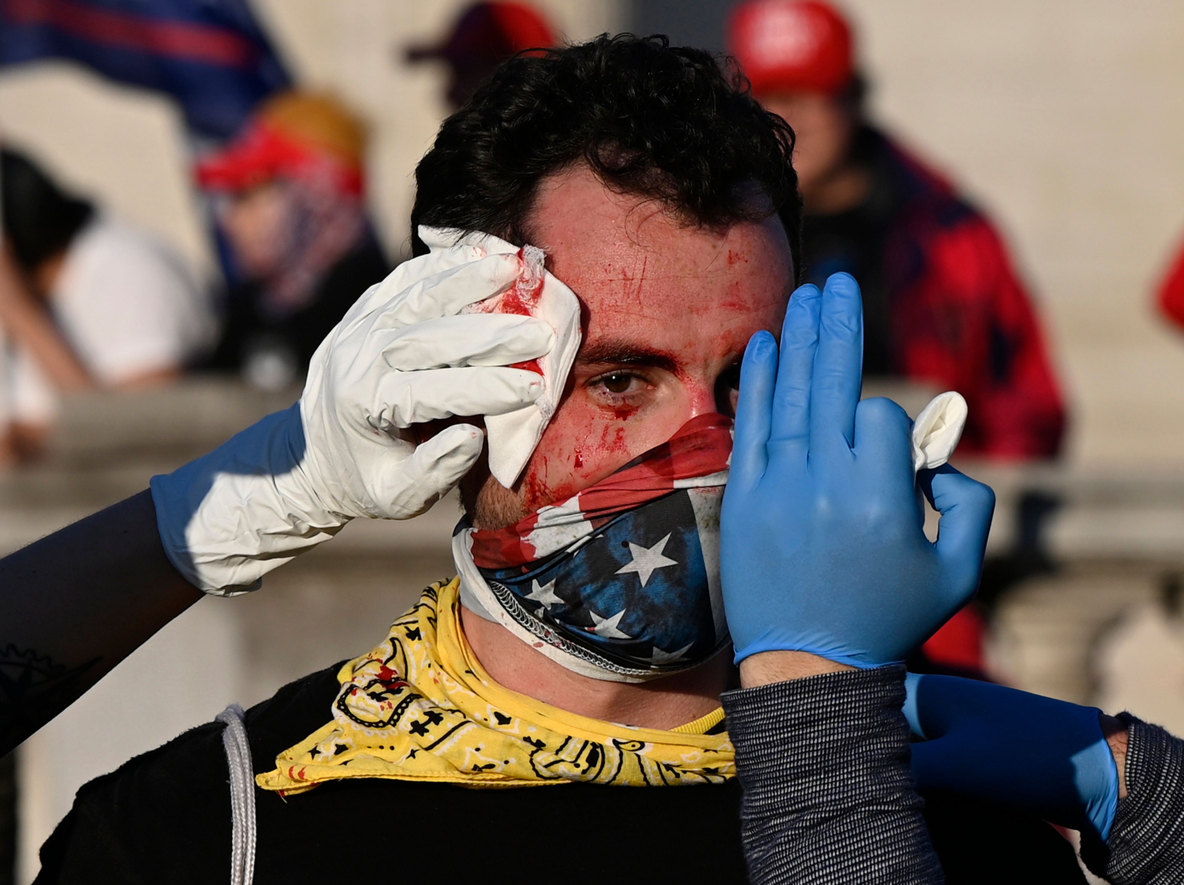 An injured supporter of US President Donald Trump is helped after being assaulted by an unknown assailant in Washington, DC, during a rally on November 14, 2020. 8V899A.jpg